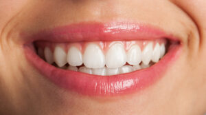 blanqueamiento-dental