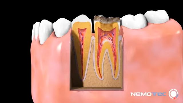 Caries dental y cómo se empasta