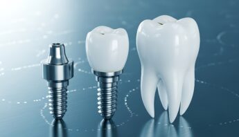 implantes-dentales-zaragoza